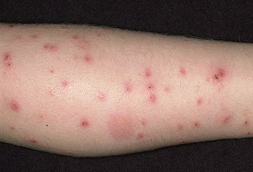 bed-bug-bites