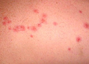 Bed Bug Bites