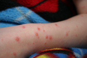 chicken-pox