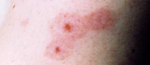 Flea Bites on Arm