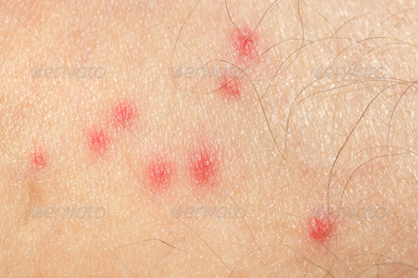 Mosquito BItes