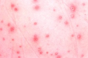 Scabies