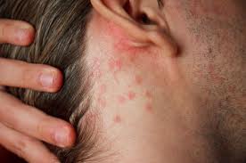 Skin Allergy