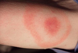 tick-bite-1