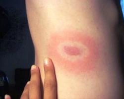 tick-bite-2