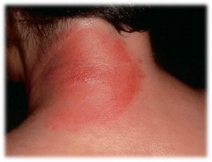 tick-bite-3