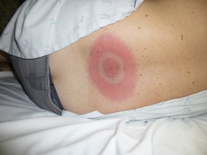 tick-bite-4