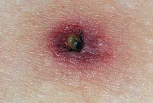 Tick Feeding on a Human