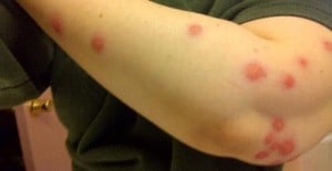 bed-bug-bites
