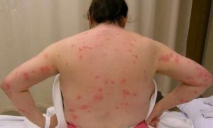 bed-bug-bites-2