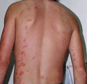 bed-bug-bites