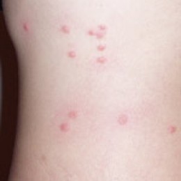 flea-bites
