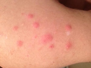 bed-bug-bites-4