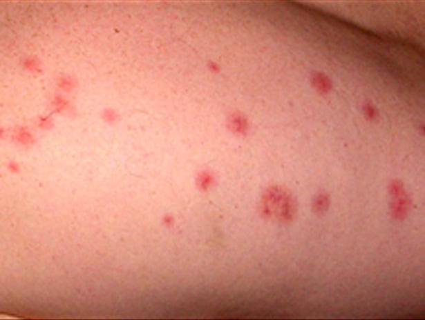 bed-bug-bites-5