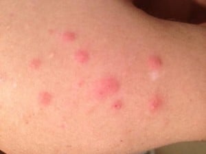 bedbug-bites