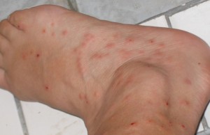 bed-bug-bites-7
