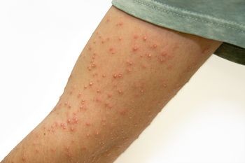 bed-bug-bites-12