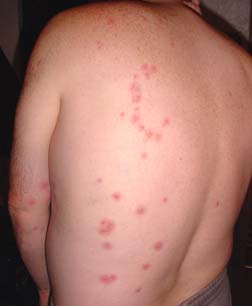 Bed Bug Bites